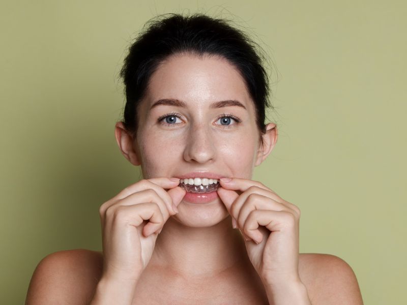 alinhadores dentais preço