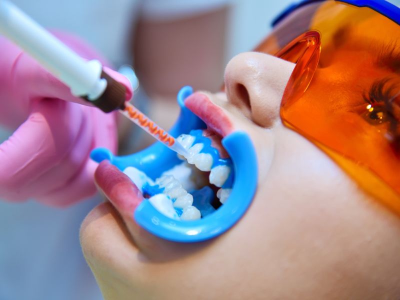 melhor clareamento dental brasilia sensibilidade