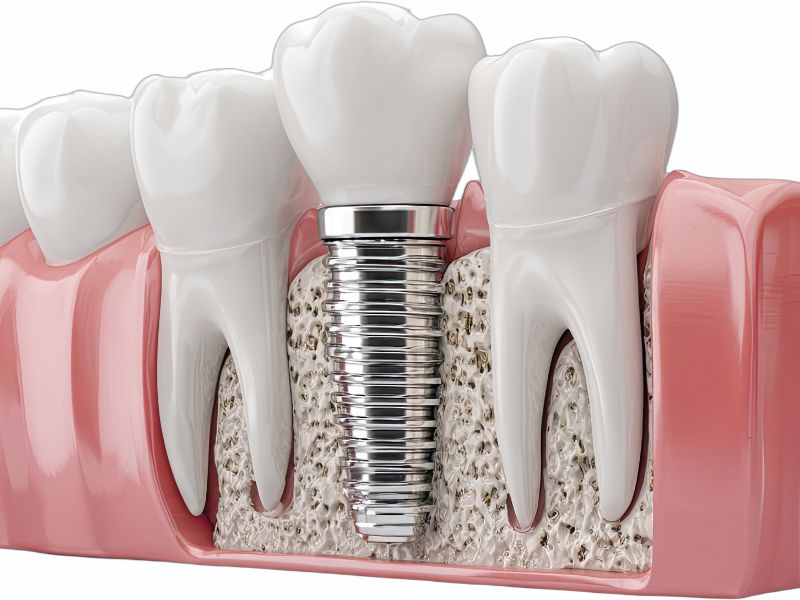 tipos de implante dentário