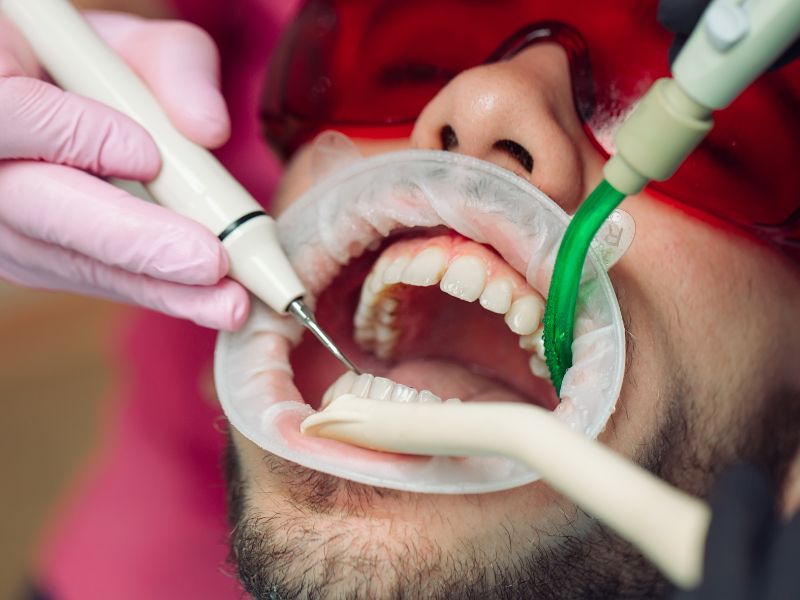 Custo de uma limpeza profunda nos dentes no DF: qual o valor?