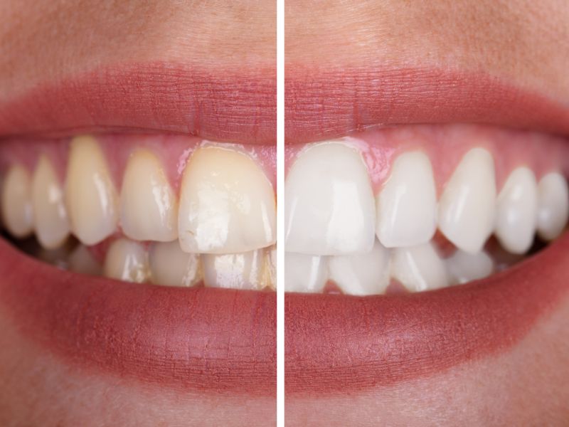 Custo de uma limpeza profunda nos dentes no DF: quanto custa? — Para quais casos a limpeza profunda nos dentes é indicada